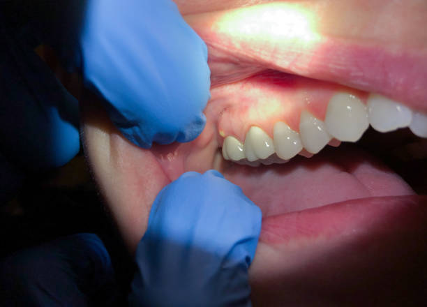 Best Emergency Root Canal Treatment in Quail Ridge, FL